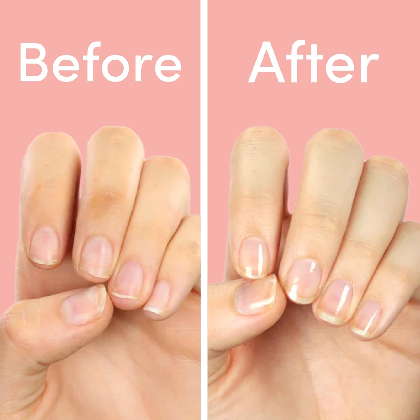 ella+mila Nail Strengthener and Growth Treatment - First Aid Kiss Nail Hardener for Damaged Brittle Thin Nails