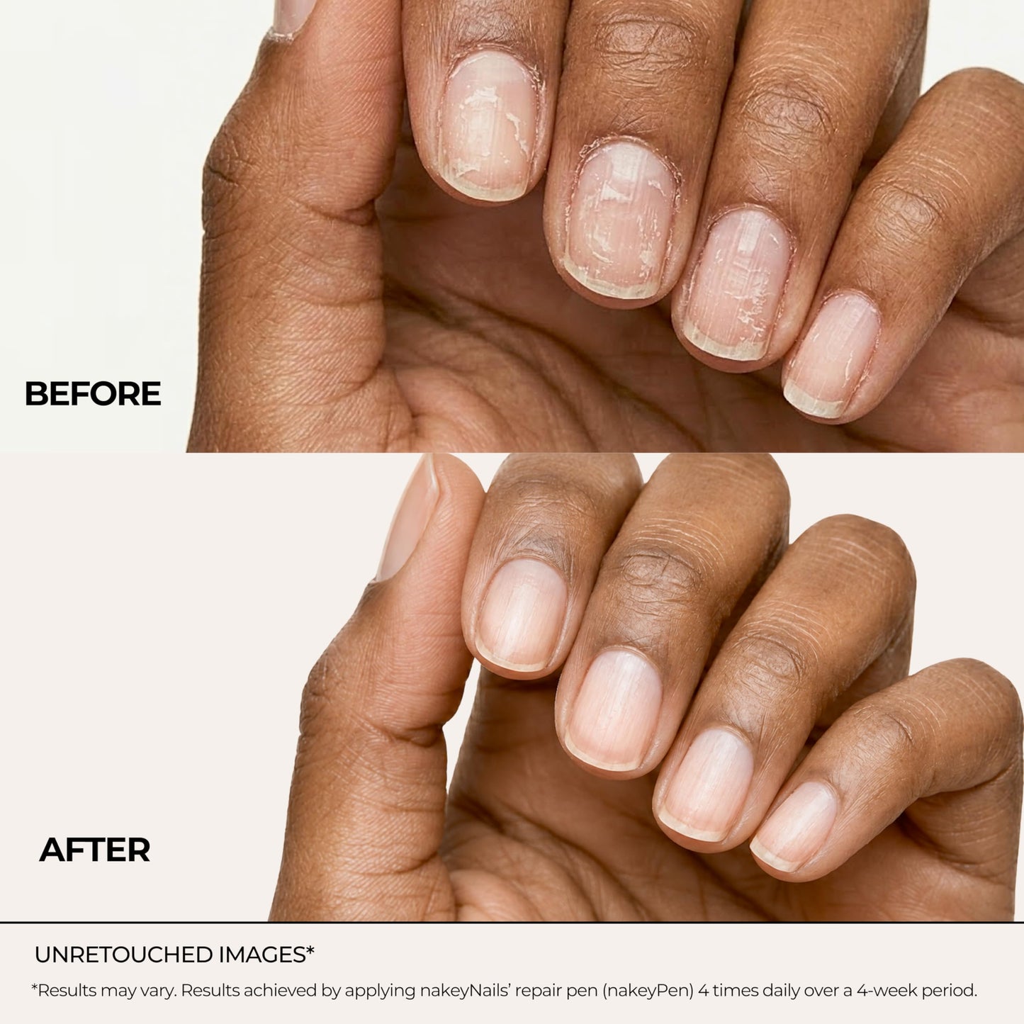 Fast Absorbing Nail Strengthening Serum for Damaged, Brittle & Thin Nails — Post-Acrylic & Gel Damage Treatment with Keratin, Peptides, Hyaluronic Acid & Niacinamide — 45-Day Supply by nakeyNails