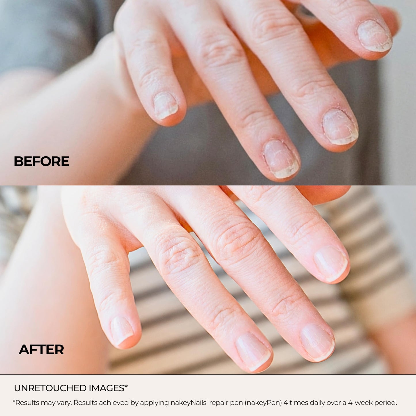 Fast Absorbing Nail Strengthening Serum for Damaged, Brittle & Thin Nails — Post-Acrylic & Gel Damage Treatment with Keratin, Peptides, Hyaluronic Acid & Niacinamide — 45-Day Supply by nakeyNails